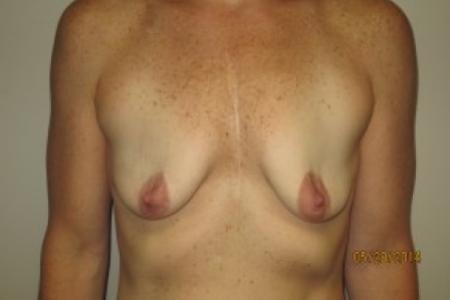 Before image 1 Case #82411 - 40 Female Breast Augmentation
