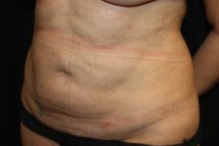 Before image 2 Case #84831 - Abdominplasty - 43 year old female.