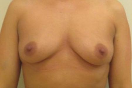 Before image 1 Case #82646 - Breast Augmentation (30 year old)