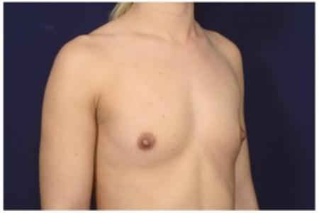 Before image 2 Case #86271 - 26 year old woman treated with Breast Augmentation