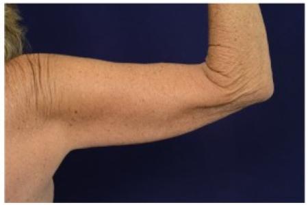 Before image 2 Case #87021 - Upper Arm Lift