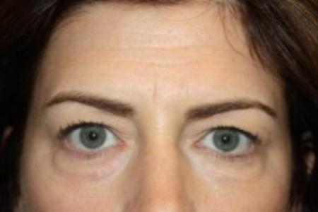 Before image 1 Case #85171 - Blepharoplasty and Browlift - 45 year old female