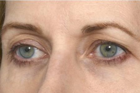 Before image 2 Case #87621 - Eye Area Rejuvenation