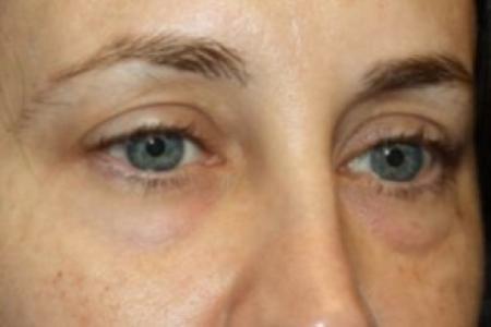 Before image 2 Case #84531 - Blepharoplasty - Lower Lids Only - 41 year old female