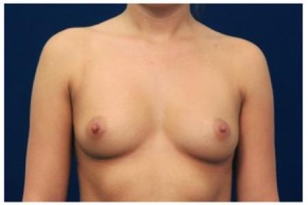 Before image 1 Case #87691 - Breast Augmentation
