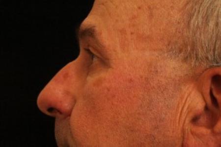 Before image 2 Case #81731 - Eyelid Surgery