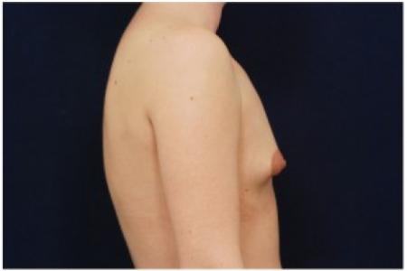 Before image 3 Case #81961 - Breast Augmentation