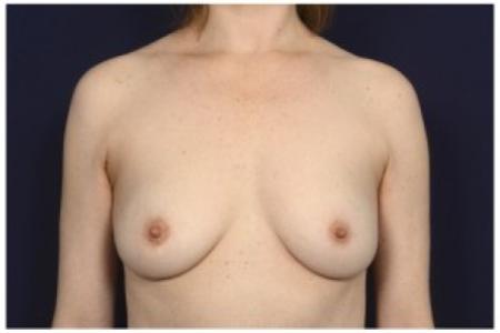 Before image 1 Case #86236 - 39 year old woman treated with Breast Augmentation