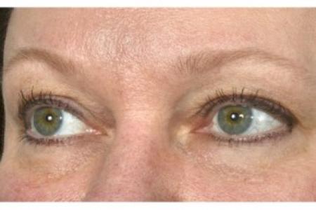 Before image 3 Case #87121 - Eye Area Rejuvenation
