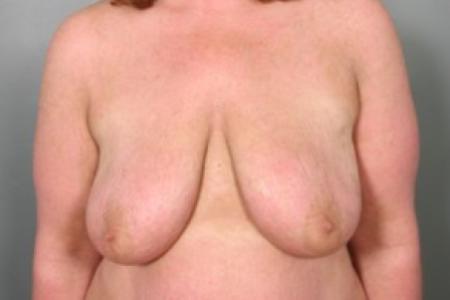 Before image 1 Case #83351 - Augmentation Mastopexy with Saline Implants