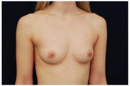 Before image 2 Case #81971 - Breast Augmentation