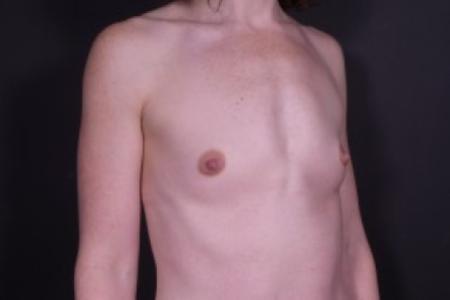 Before image 2 Case #85616 - Breast Augmentation with Shaped Silicone Implants