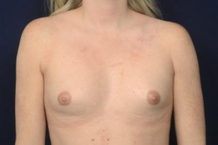 Before image 1 Case #87456 - Breast Augmentation