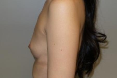 Before image 3 Case #82421 - 33 Female Breast Augmentation