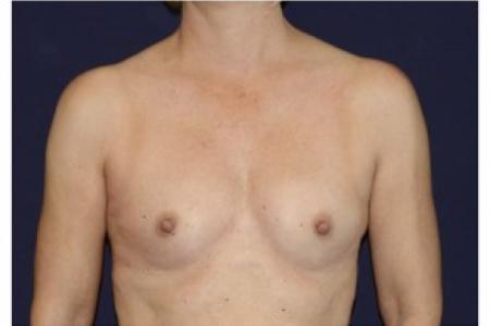 Before image 1 Case #87076 - Breast Augmentation