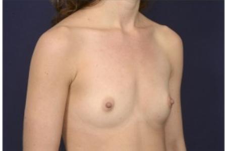 Before image 2 Case #86871 - Breast Augmentation