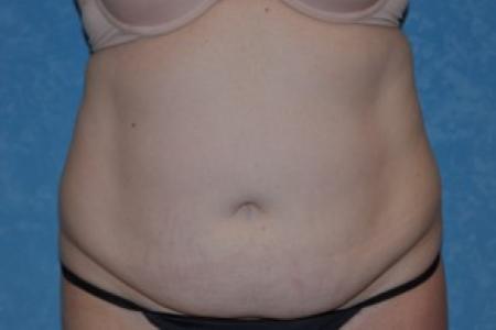 Before image 1 Case #83951 - Liposuction Before and After 