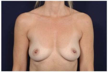Before image 1 Case #86231 - 49 year old woman treated with Breast Augmentation