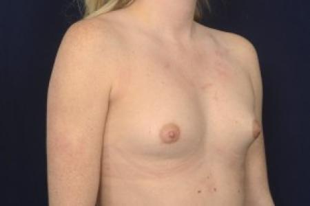 Before image 2 Case #87456 - Breast Augmentation