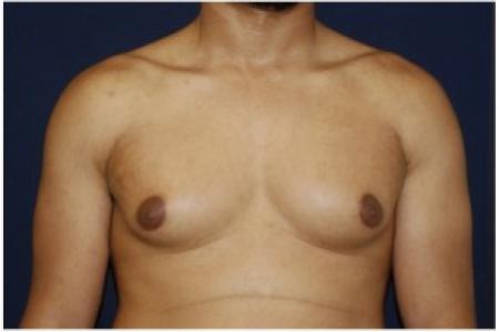 Before image 1 Case #82076 - Gynecomastia