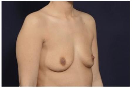 Before image 2 Case #84786 - Breast Augmentation
