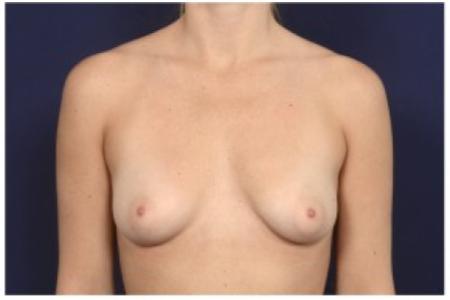 Before image 1 Case #86266 - 29 year old woman treated with Breast Augmentation