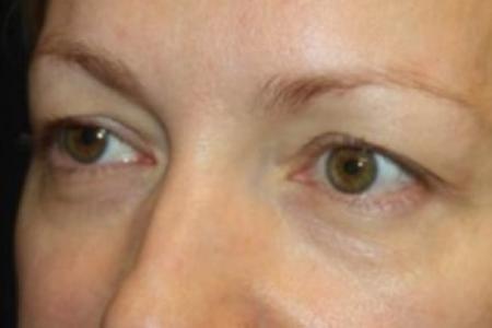 Before image 2 Case #85046 - Blepharoplasty - Upper Lids Only - 46 year old female