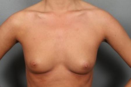 Before image 1 Case #83436 - Breast Augmentation with Submuscular Round Silicone Implants