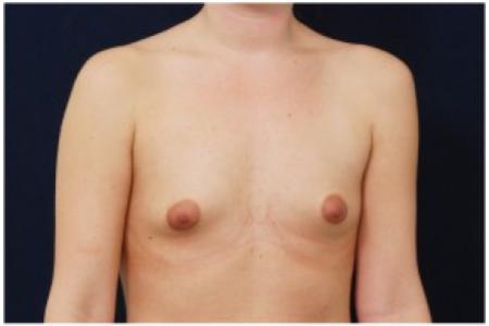 Before image 2 Case #81961 - Breast Augmentation