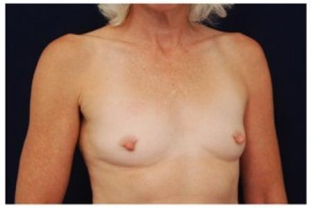 Before image 2 Case #81981 - Breast Augmentation