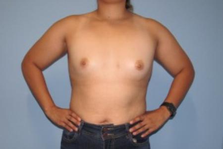Before image 1 Case #87201 - Breast Augmentation in 25 year-old