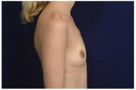 Before image 3 Case #86926 - Breast Augmentation