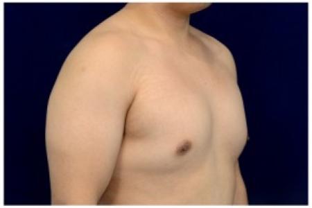 Before image 2 Case #82176 - Gynecomastia
