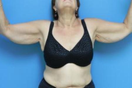 Before image 1 Case #80946 - Bilateral Brachioplasty Procedure