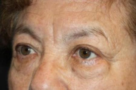 Before image 2 Case #84706 - Blepharoplasty and Brow Lift - 78 year old female.