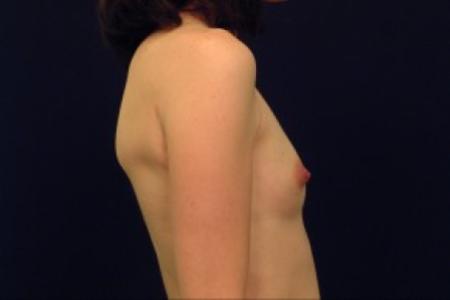 Before image 3 Case #87671 - Breast Augmentation