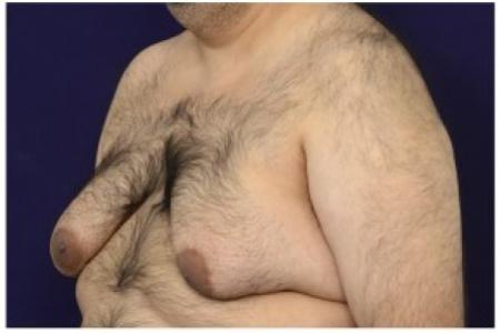 Before image 2 Case #86921 - Gynecomastia