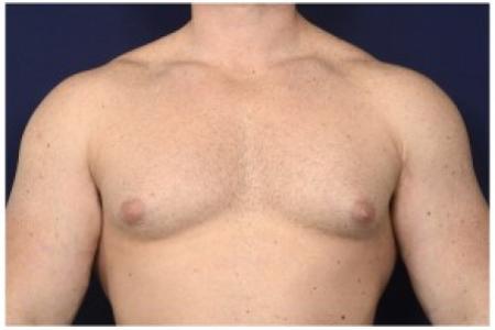 Before image 1 Case #86196 - 32 year old man treated with Male Breast Reduction