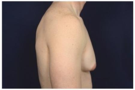 Before image 3 Case #85596 - Gynecomastia
