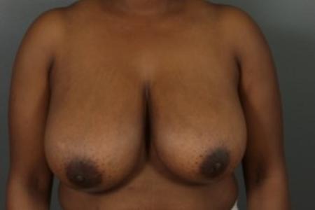 Before image 1 Case #83356 - Breast Reduction