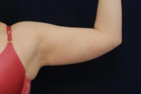 Before image 1 Case #87721 - Upper Arm Liposuction
