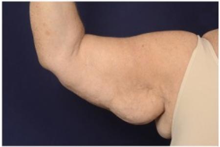 Before image 1 Case #87501 - Brachioplasty