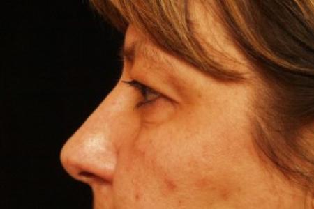 Before image 2 Case #81741 - Eyelid Surgery