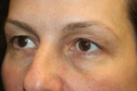 Before image 2 Case #85871 - Blepharoplasty and Browlift - 49 year old female