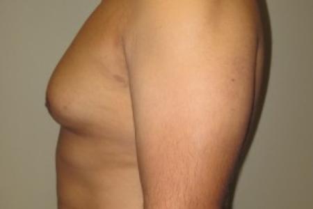 Before image 3 Case #82406 - 37 Male Gynecomastia