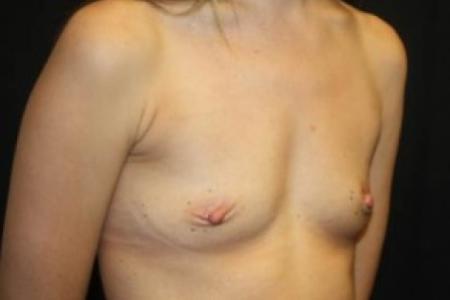 Before image 2 Case #84926 - Breast Augmentation - 33 year old female