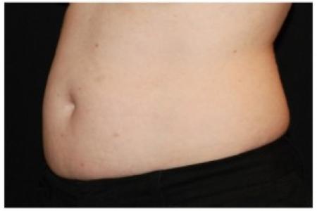 Before Case #86356 - 40 yr old treated with nonsurgical fat reduction.