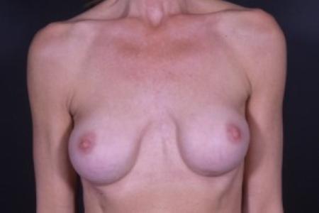 Before image 1 Case #83811 - Implant Removal