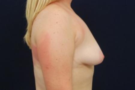 Before image 3 Case #87716 - Augmentation Mastopexy