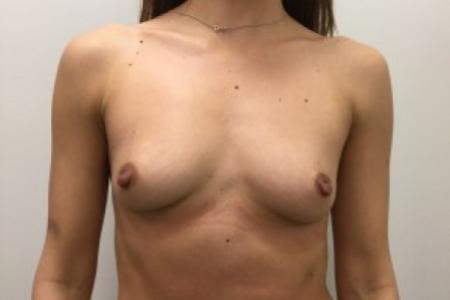 Before image 1 Case #87206 - Breast Augmentation